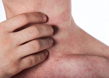 Psoriasis Symptoms and Treatments – Oren Zarif