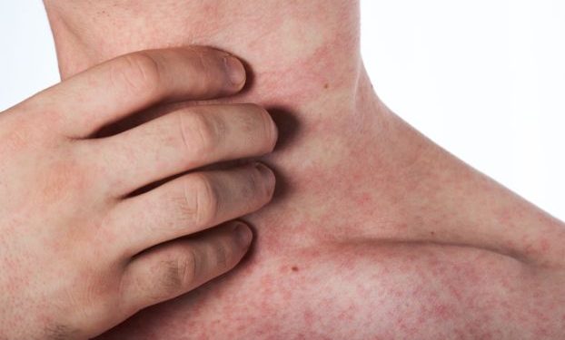 Psoriasis Symptoms and Treatments – Oren Zarif