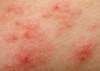Psoriasis Causes – Oren Zarif