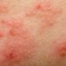Psoriasis Causes – Oren Zarif