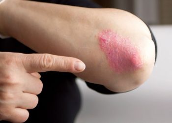 Psoriasis Symptoms and Treatments – Oren Zarif