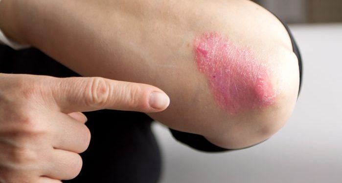 Psoriasis Symptoms and Treatments – Oren Zarif