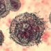 Skin Cancer Diagnosis and Treatment – Oren Zarif