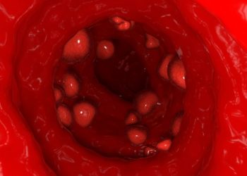 Symptoms of Skin Cancer – Oren Zarif