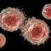 Skin Cancer Treatment – Oren Zarif