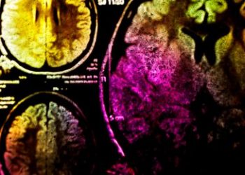 Cerebral Event Symptoms – Oren Zarif