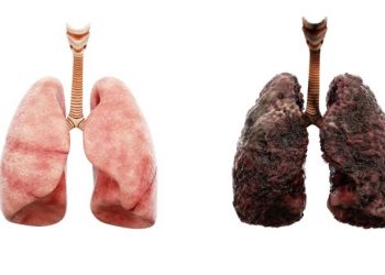 Lung Cancer Symptoms and Diagnosis – Oren Zarif