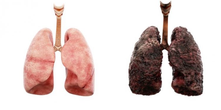 Lung Cancer Symptoms and Diagnosis – Oren Zarif