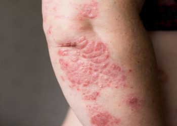 Skin Cancer is also Caused by Excessive Exposure to the Sun – Oren Zarif