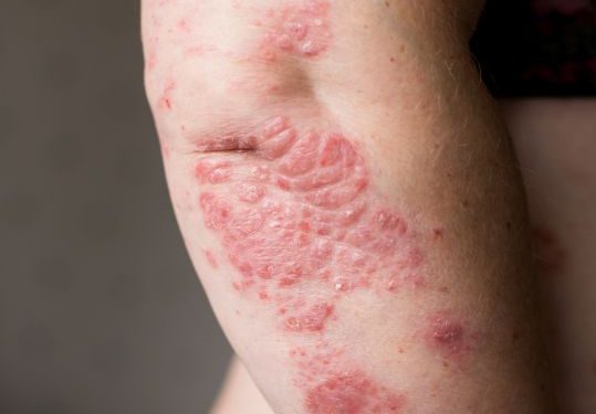 Skin Cancer is also Caused by Excessive Exposure to the Sun – Oren Zarif