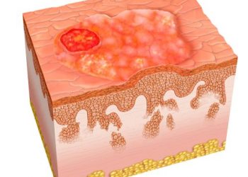 Why Cancer is Bad? – Oren Zarif