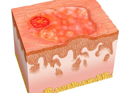 Why Cancer is Bad? – Oren Zarif