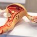 Can Cancer Cause High Blood Pressure? – Oren Zarif