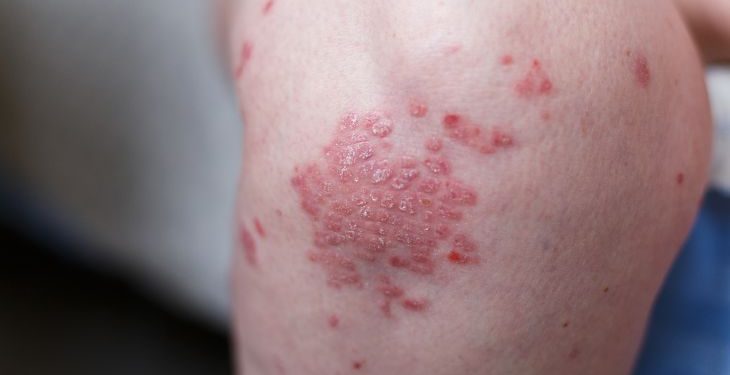 How Cancer Affects the Body? – Oren Zarif