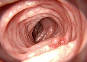 How Long Can You Expect to Live With Cancer Without Treatment? – Oren Zarif