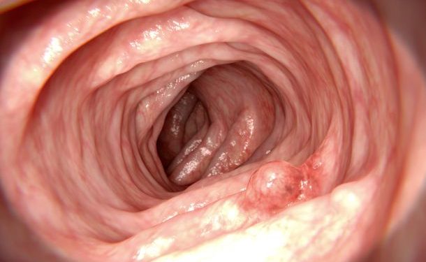 How Long Can You Expect to Live With Cancer Without Treatment? – Oren Zarif