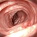How Long Can You Expect to Live With Cancer Without Treatment? – Oren Zarif