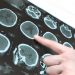 Which Cancer is the Most Curable? – Oren Zarif