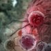 Symptoms and Signs of Mouth Cancer – Oren Zarif