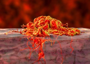 How Colon Cancer is Treated – Oren Zarif