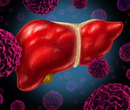 Important Things to Know About Cancer Stage 1 – Oren Zarif