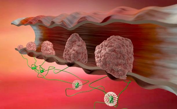 Is Endometriosis Cancer? – Oren Zarif