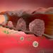 Is Endometriosis Cancer? – Oren Zarif