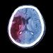 Cancer of the Endometrium – Risk Factors – Oren Zarif
