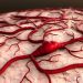 Head and Neck Cancer Stages – Oren Zarif