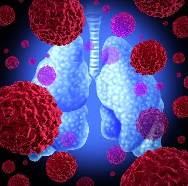 Endometrial Cancer Symptoms – Oren Zarif – Endometrial Cancer