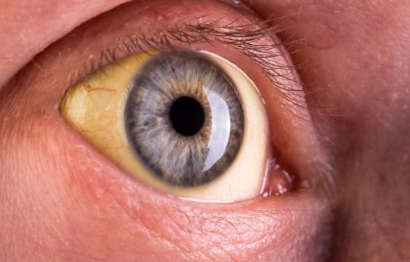 Cancer Stage 4 Symptoms – Oren Zarif