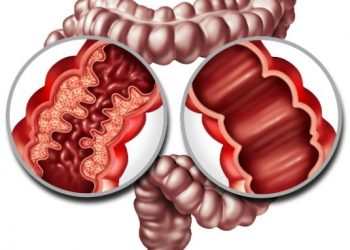 Diaphragmatic hernia