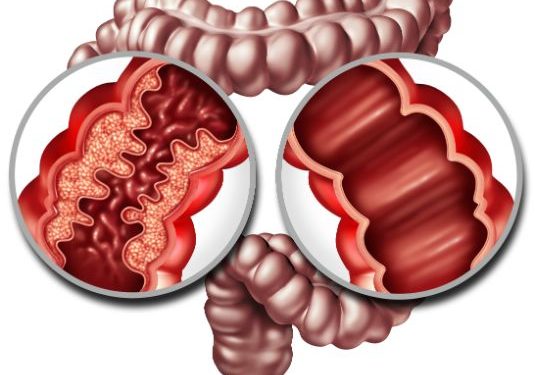Diaphragmatic hernia