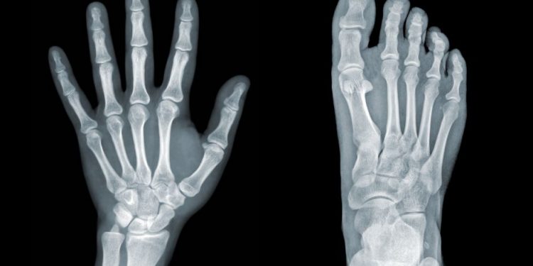 Hypertrophic Osteoarthropathy