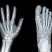 Hypertrophic Osteoarthropathy