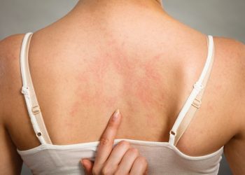 Urticaria Symptoms and Angioedema