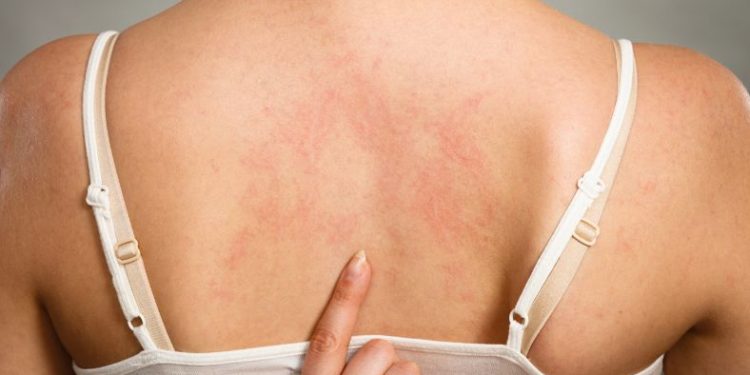 Urticaria Symptoms and Angioedema