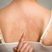 Urticaria Symptoms and Angioedema
