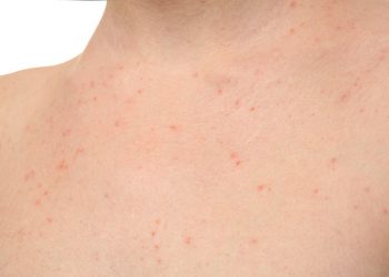 Ehrlichiosis Symptoms