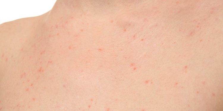 Ehrlichiosis Symptoms