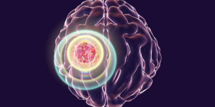 How to Beat Brain Cancer?