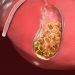 Gallstones Symptoms