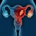 Symptoms of Uterine Cancer