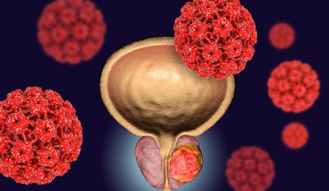 Bladder Cancer Symptoms