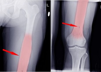 Osteosarcoma Symptoms and Treatment