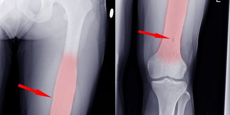 Osteosarcoma Symptoms and Treatment