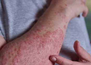 Symptoms of Psoriasis