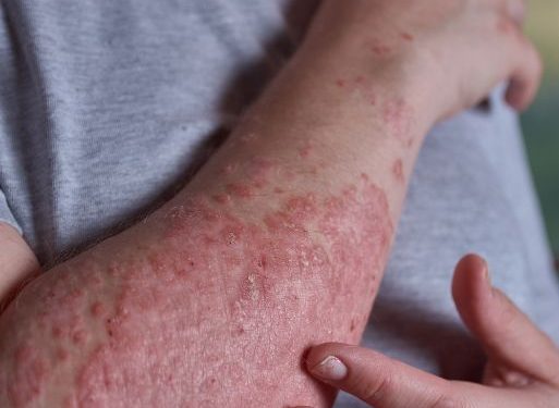 Symptoms of Psoriasis