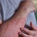 Symptoms of Psoriasis