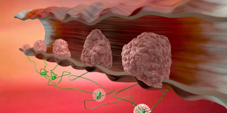 Colon Cancer Symptoms